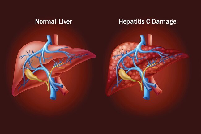 hepatitis c