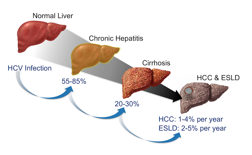 hepatitis c stages