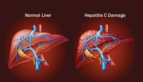 Dacihep – A helping aid towards hepatitis C virus