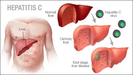 What is Hepatitis C and its Causes and Symptoms of the Infection?