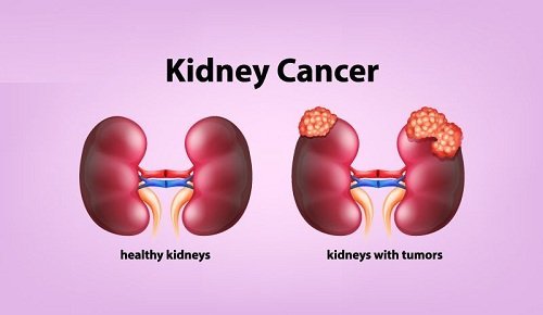 Kidney Cancer and its Treatments