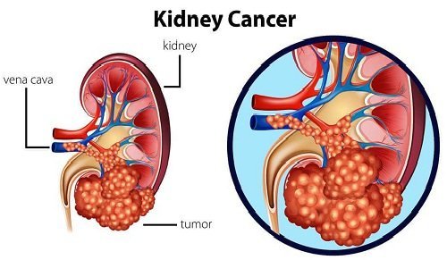 Take Lenvakast 4mg to treat Renal Cell Carcinoma