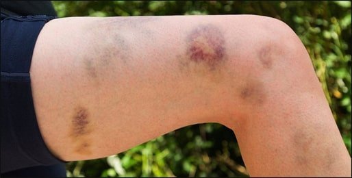 How to Manage Low Platelet Count due to ITP or HCV Infection?