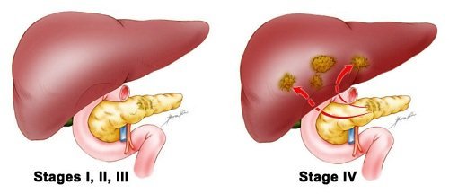 Erlotinib for Pancreatic and Lung Cancer: A first-line Treatment