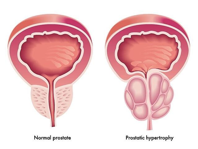 What are the First Signs of Prostate Problems?