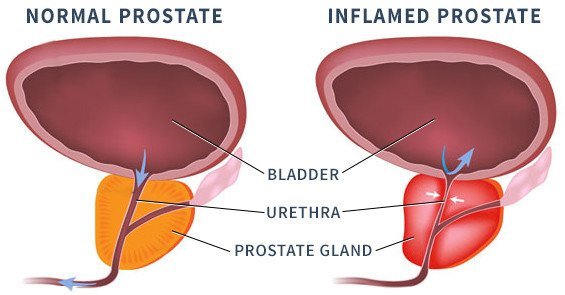 What are the 5 Common Warning Signs of Prostate Cancer?