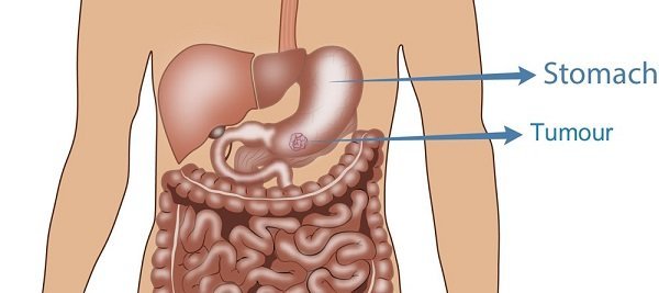 Gastrointestinal Stromal Tumors