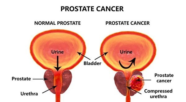 How to Prevent Prostate Cancer?