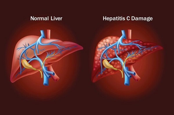 What are the Symptoms and Causes of Hepatitis C?