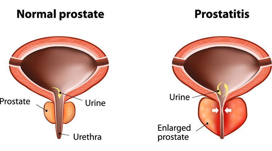 What are the Warning Signs of Prostate Cancer?