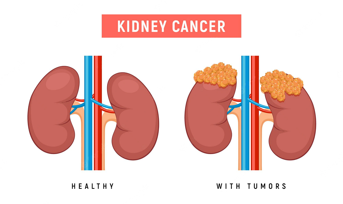 What are the Early Signs of Kidney Cancer?