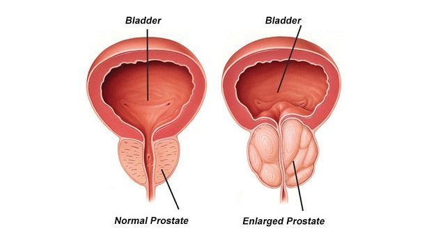 Prostate Cancer Symptoms and Treatment: What to Check for