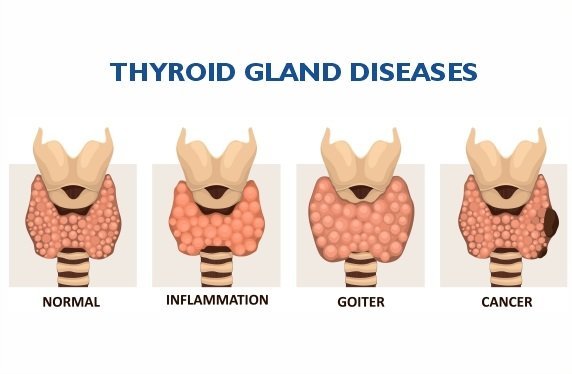 What are the Early Signs and Symptoms of Thyroid Cancer?