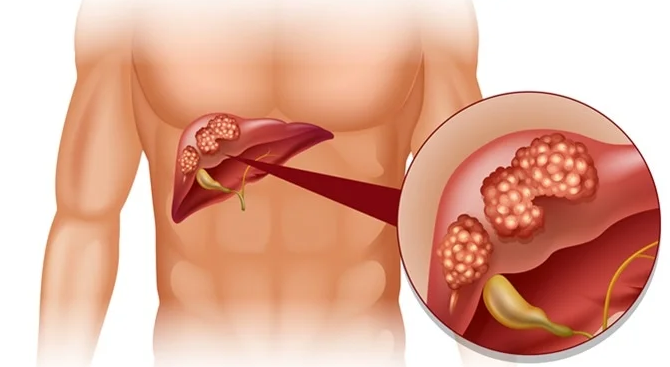 How Long can you Live with Liver Cancer?