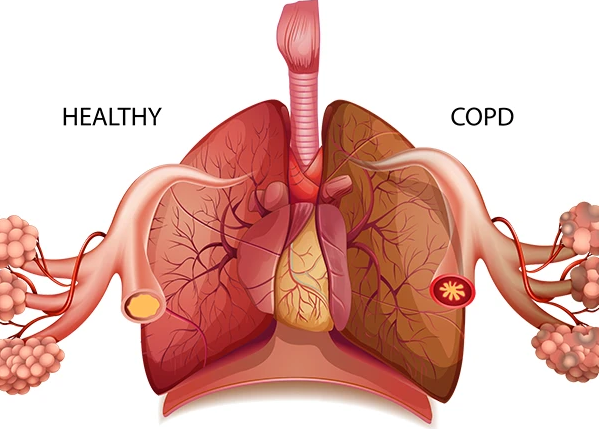 Ab flo n tablet for copd